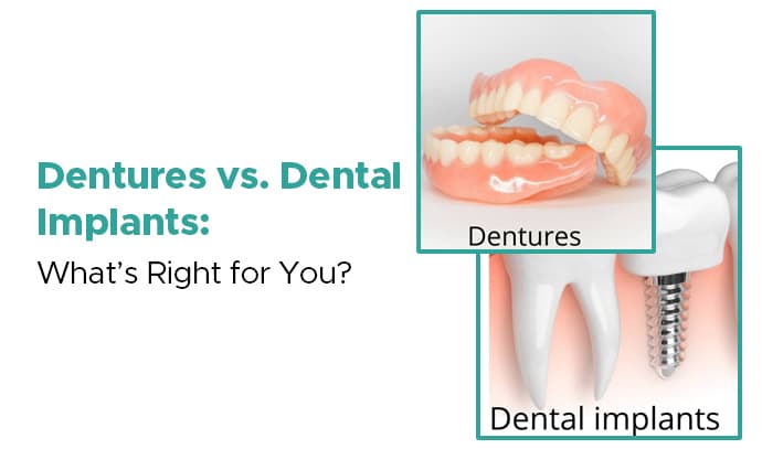 Dentures vs. Dental Implants: What’s Right for You