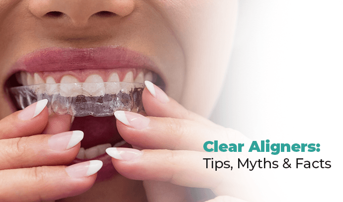 Clear Aligners: Tips, Myths & Facts