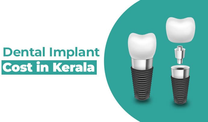 Dental Implant Cost in Kerala