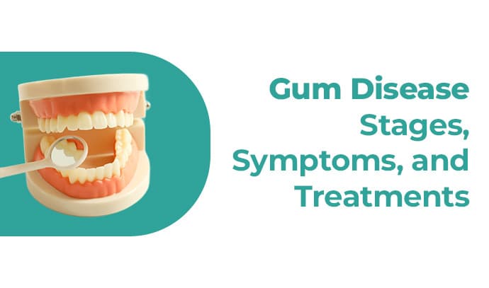 Gum Disease: Stages, Symptoms, and Treatments