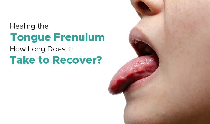 Healing the Tongue Frenulum: How Long Does It Take to Recover?
