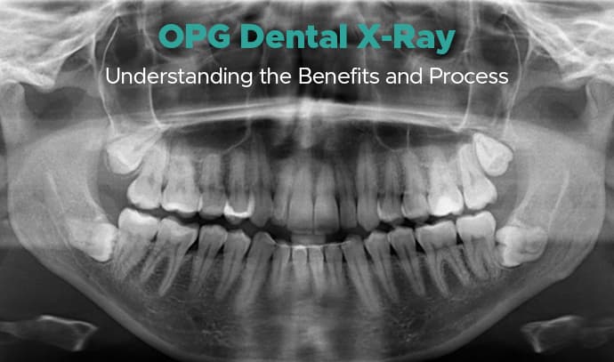 OPG Dental X-Ray: Understanding the Benefits and Process
