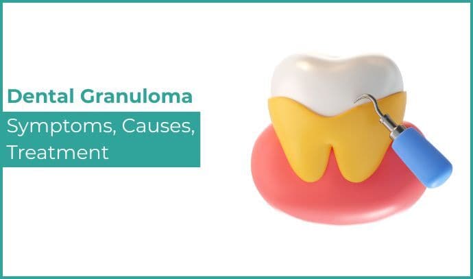 Dental Granuloma – Symptoms, Causes, Treatment