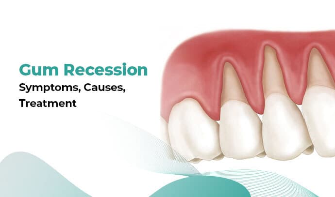 Gum Recession – Symptoms, Causes, Treatment