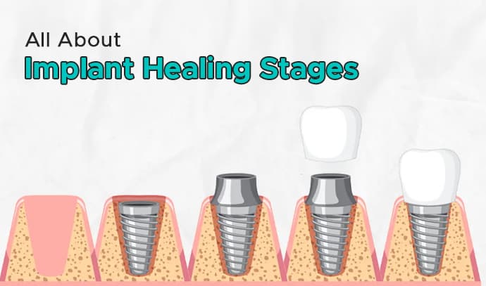 All About Implant Healing Stages