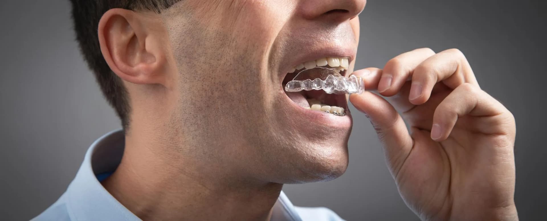 Invisible Aligners