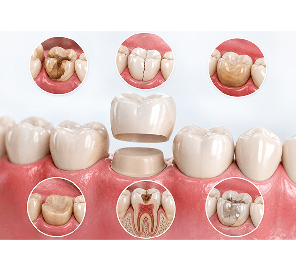 Dental Crowns treatment examples