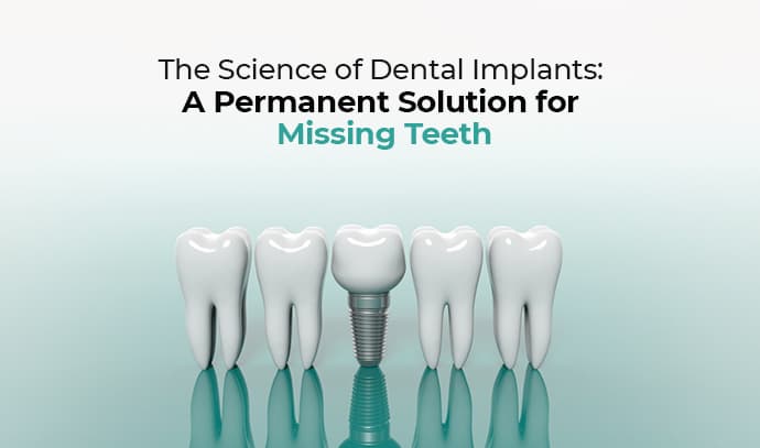 Dental implants