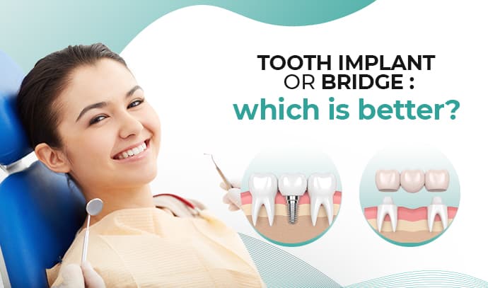 tooth implant or bridge