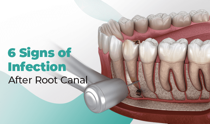 root canal