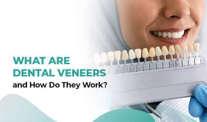 Dental veneers