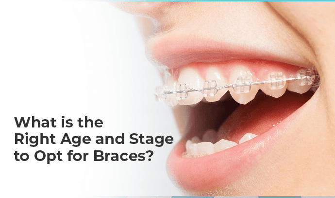 what is the right age and stage to opt for braces