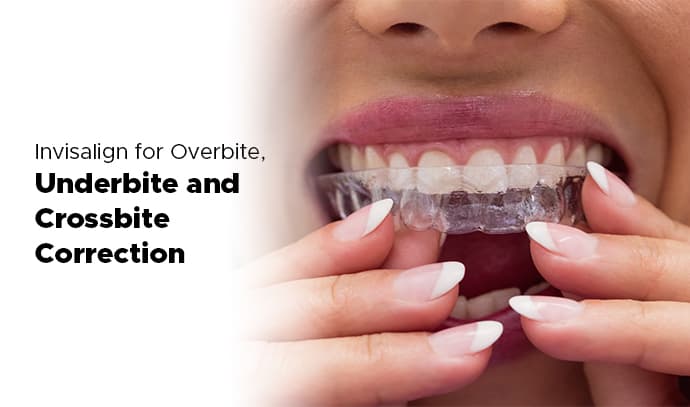 invisalign for overbite underbite and crossbite correction