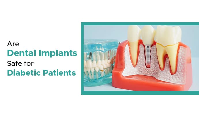 are dental implants safe for diabetic patients