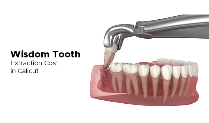 Wisdom Tooth Extraction Cost in Calicut