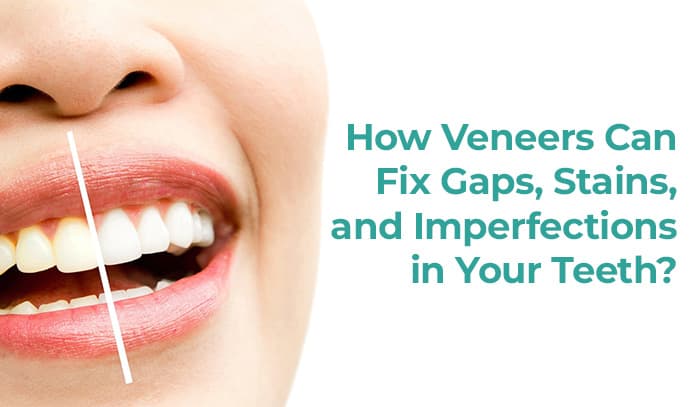 How Veneers Can Fix Gaps, Stains, and Imperfections in Your Teeth?