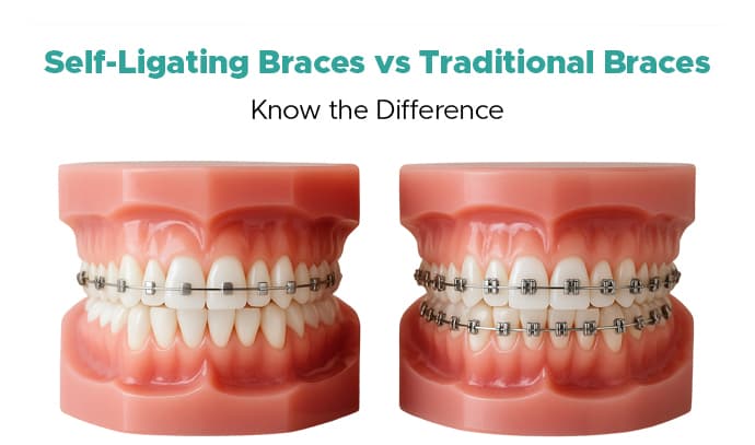 Self-Ligating Braces vs Traditional Braces