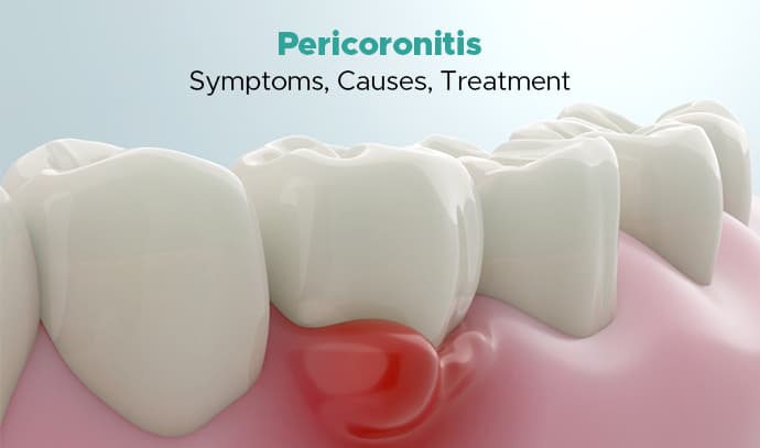 elite dental pericoronitis