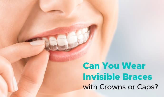 can you wear invisible braces with crowns or caps