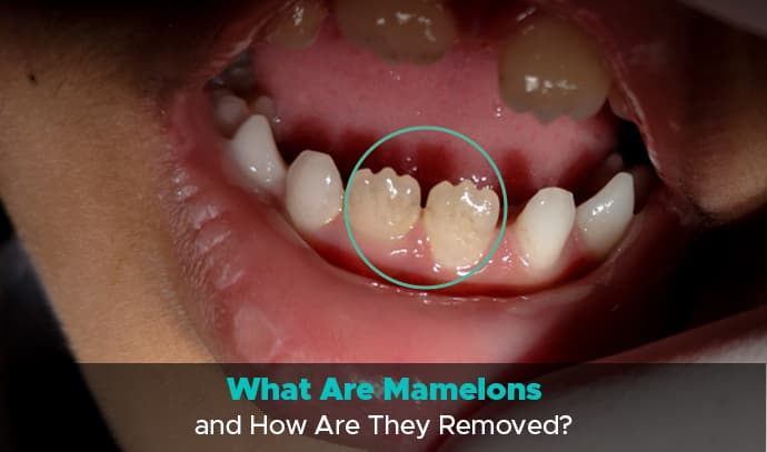 What Are Mamelons