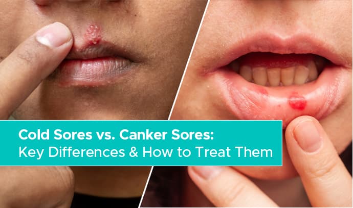 cold sores vs. canker sores