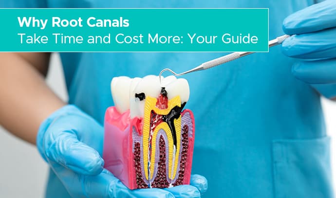 Why Root Canals Take Time and Cost More: Your Guide