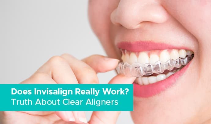 Does Invisalign Really Work? Truth About Clear Aligners