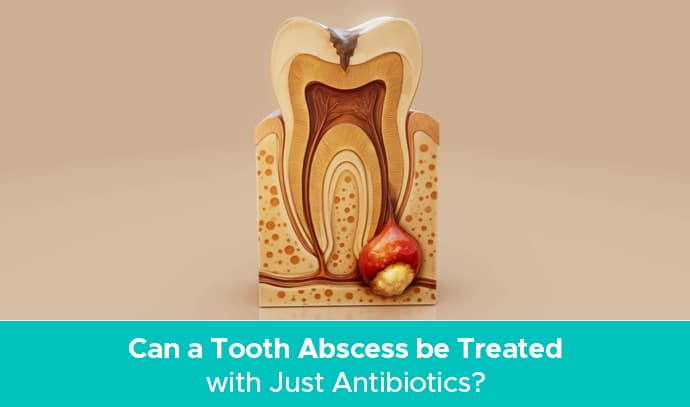tooth abscess