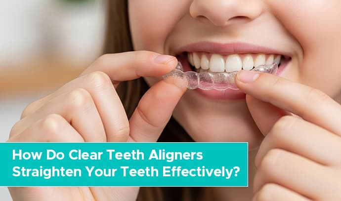 clear aligner treatment in calicut