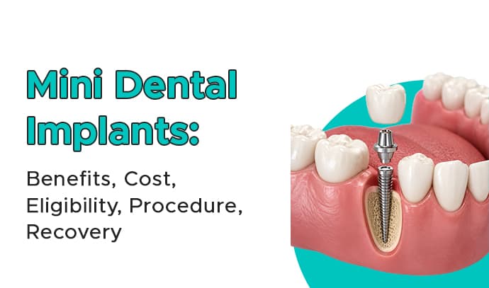 mini dental implants- benefits, cost, eligibility, procedure, recovery