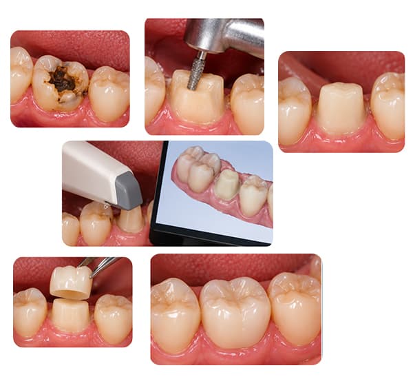 Dental laser treatment
