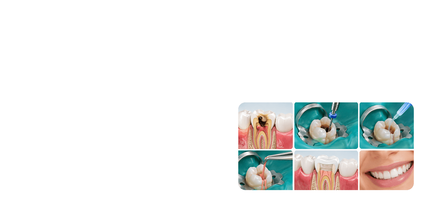 Endodontics procedure