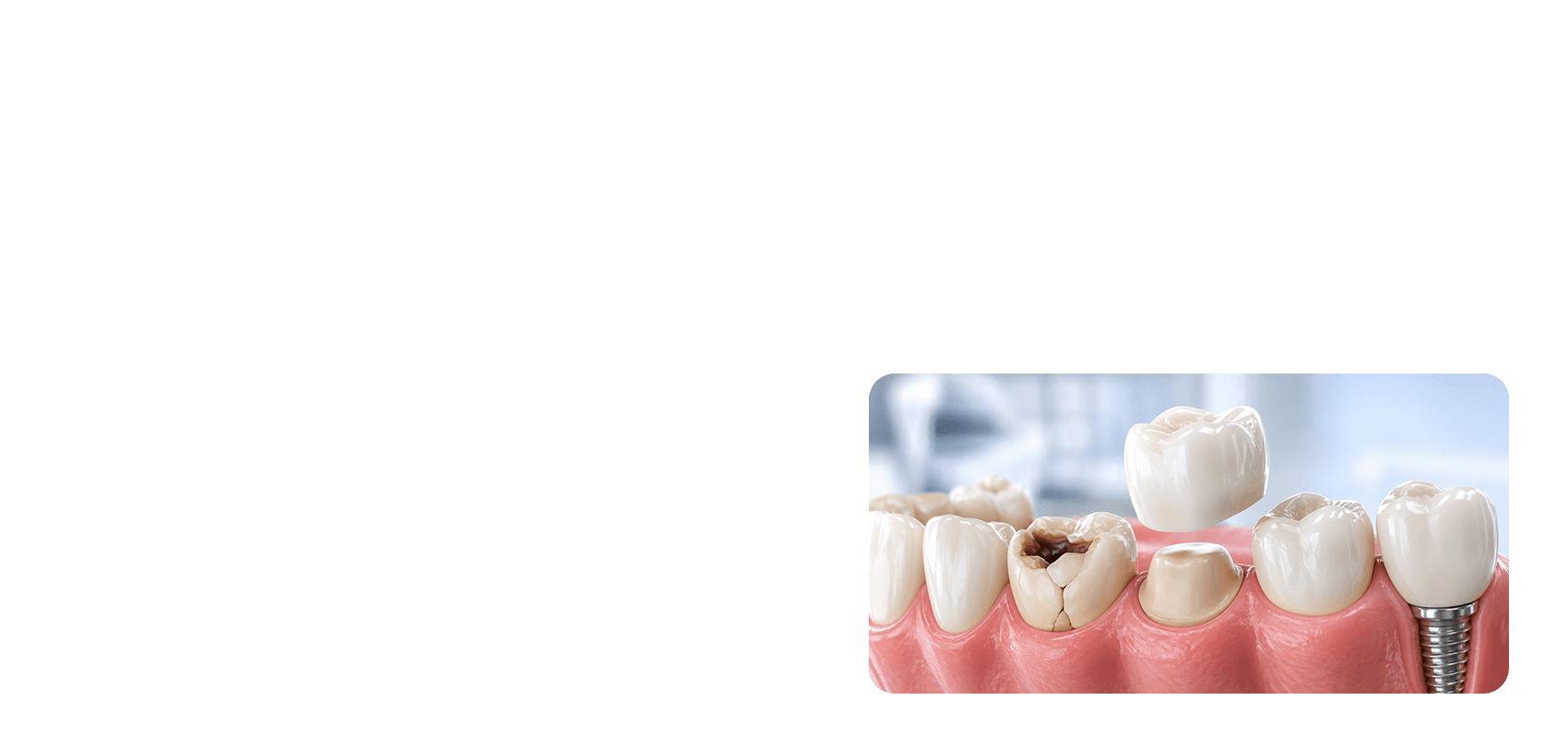 Restorative Dentistry procedure