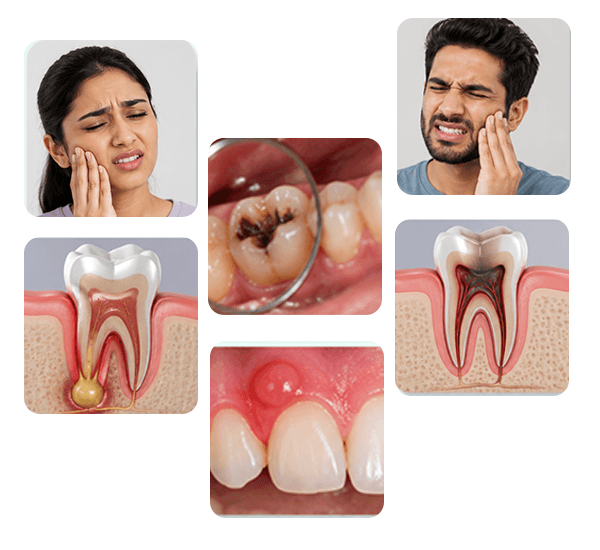 Root Canal Treatment in Coimbatore treatment examples