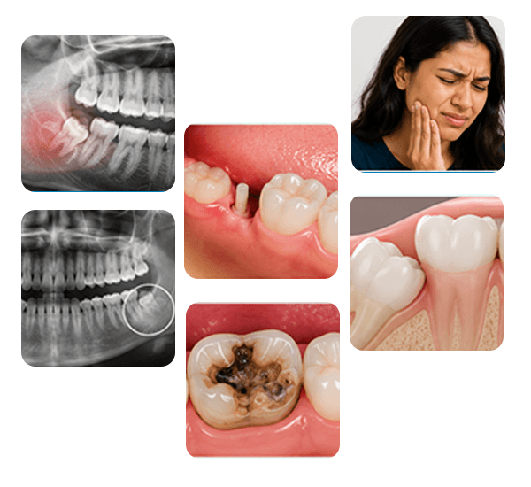 Wisdom Teeth Removal in Coimbatore treatment examples