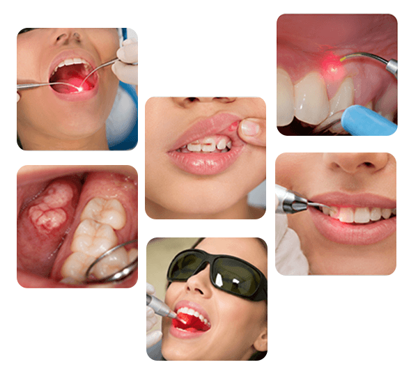 Laser Dental Clinic in Coimbatore treatment examples