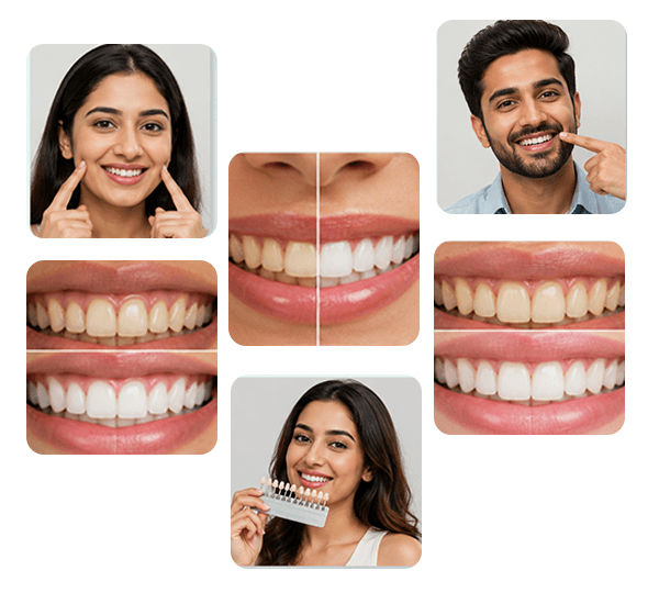 Teeth Whitening in Coimbatore treatment examples