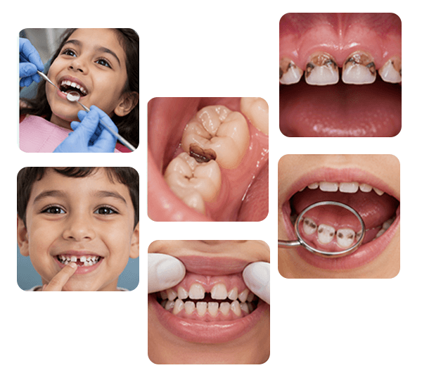 Pediatric Dentistry treatment examples