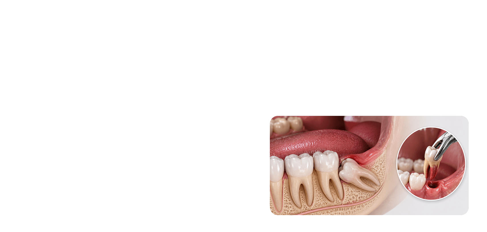 Wisdom Teeth Removal in Coimbatore procedure
