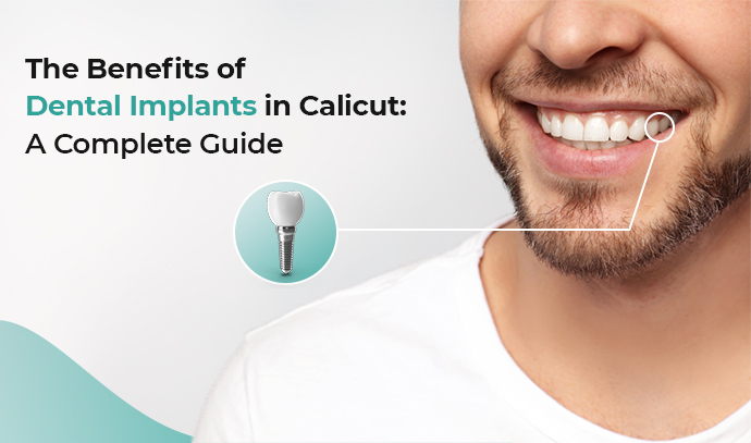 The Benefits of Dental Implants in Calicut: Complete Guide