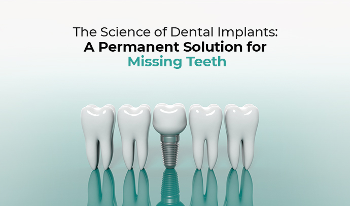 Science Of Dental Implants A Permanent Solution For Missing Teeth