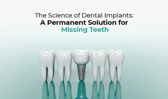 Dental implants
