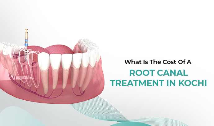 What Is The Cost Of A Root Canal Treatment In Kochi
