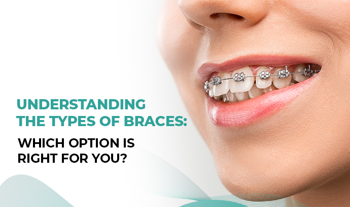 Understanding the Types of Braces: Which Option is Right for You?