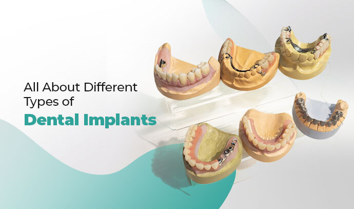 All About Different Types of Dental Implants