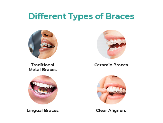 understanding the types of braces which option is right for you 