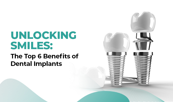Unlocking Smiles: The Top 6 Benefits of Dental Implants