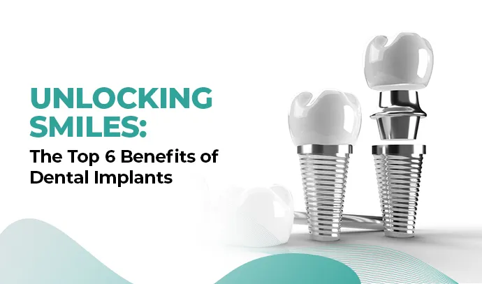 Dental Implant