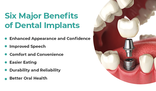 unlocking smiles the top 6 benefits of dental implants
