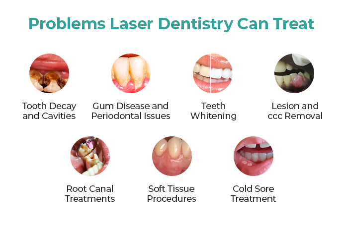 how laser dentistry can help to improve your dental experience